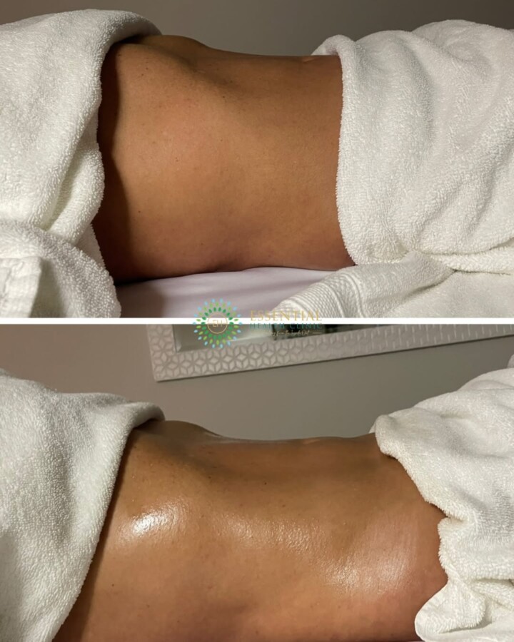 Résultats drainage lymphatique