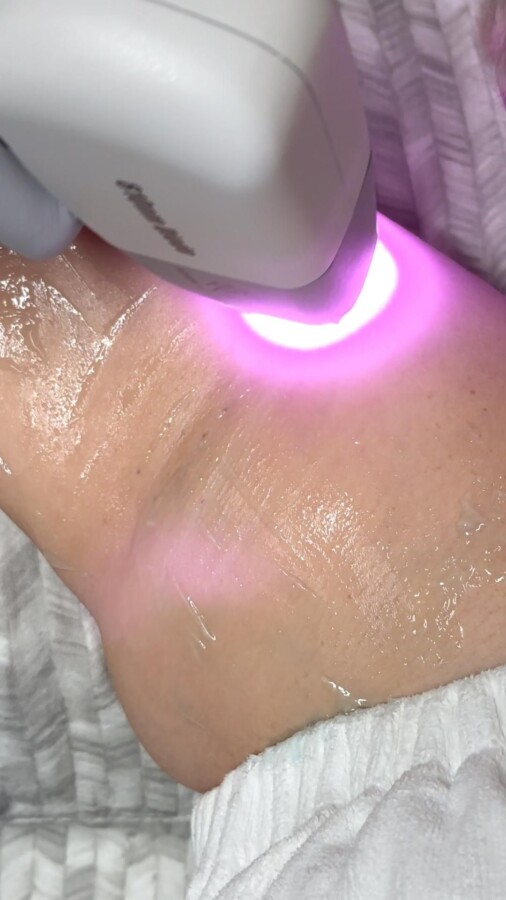 Préparation peau épilation laser