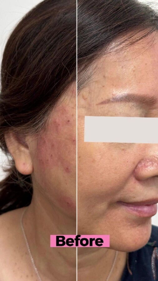 Préparation peau épilation laser