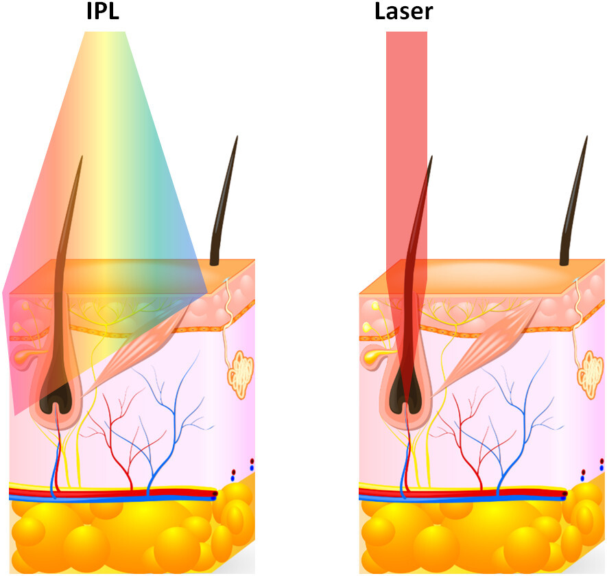 Préparation peau épilation laser