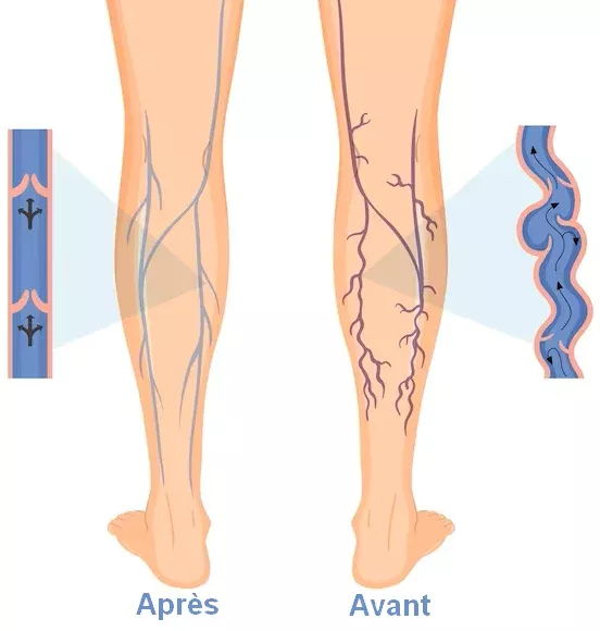 Soins post-drainage efficaces