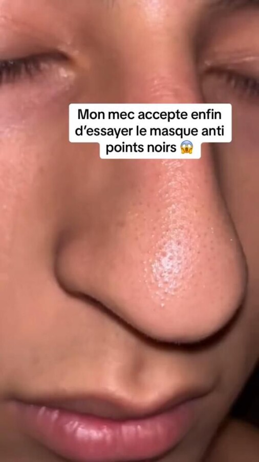 Solutions maison pour points noirs