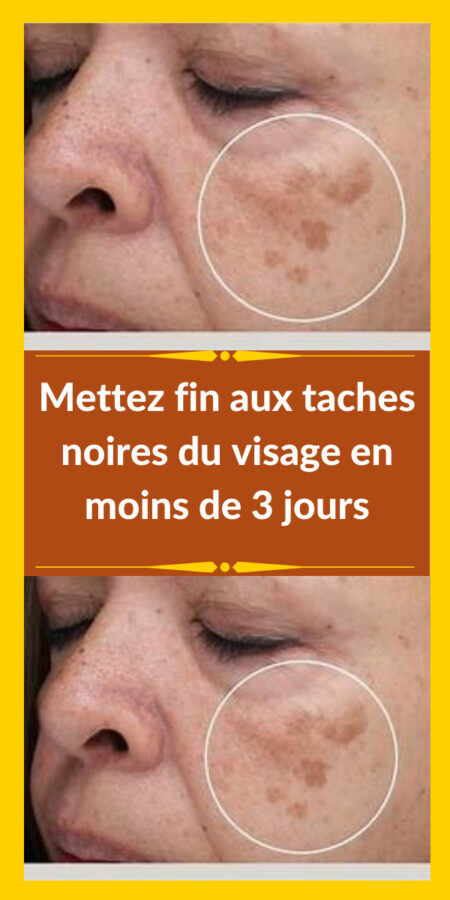 Masque DIY pour points noirs